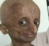 Progeria